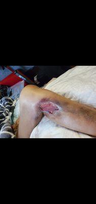 Leg Stent procedure in the process of healing