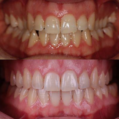 Invisalign & Teeth Whitening