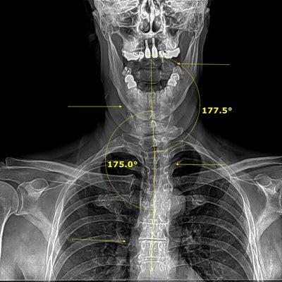 I am standing perfectly straight! S-twist in my neck, double-S kink in my thoracic/upper part of my spine :-(