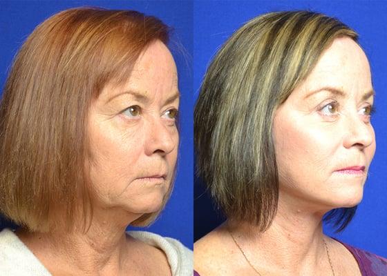 Facelift Procedure - Before & After.