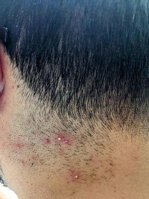 Not sure if this barber's itch or barber's rash but either way it's caused by improperly sanitized combs, scissors, or razors.