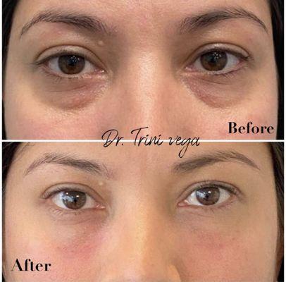 Under eyes  Fillers  Dr Trini Vega