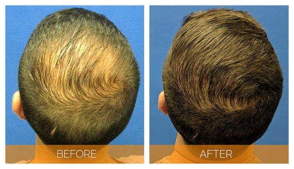 Before and after NeoGraft hair transplant at 6 months - top view