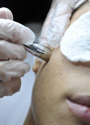 Microdermabrasion removes dead skin cells.