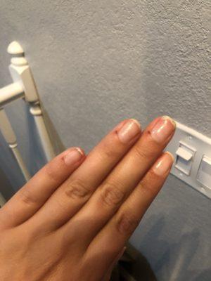 Cuts from my nails