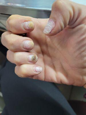 Nail fungus