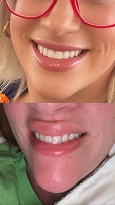 My smile before and now. Also the filler they give me is lumpy and now forms a witches chin