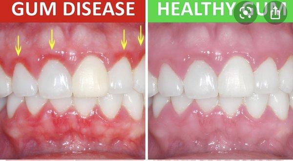 https://www.drbicuspid.com/index.aspx?sec=sup&sub=pmt&pag=dis&ItemID=328315 Almost 70% if adult population have gum disease.