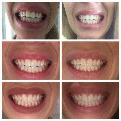 This is 12 weeks of Invisalign with Dr. Scolnick!