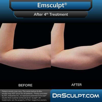 Before and after 4 EmSculpt treatments on arms.