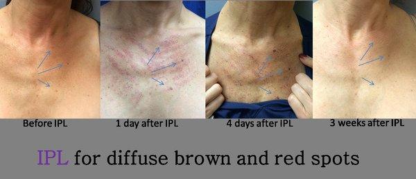 We offer IPL laser to help with red/brown discoloration, our IPL device also offers some skin tightening.