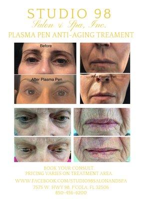 Plasma Pen Treatment by Tech & Trainer, Jayde.