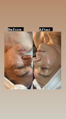 The Microdermabrasion with Firming peptide and led light therapy- the result is amazing.