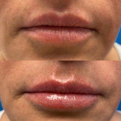 Lip Lase Treatment: it's a soft lip enhancement for natural plumpness and rejuvenation promoting collagen production.