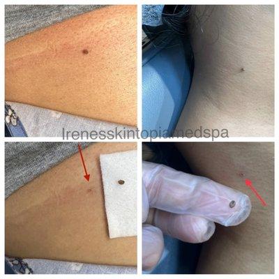 Skintag removal right after