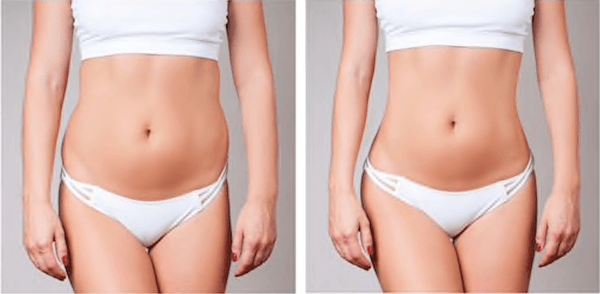 Libbe Colonic 60 min before & after