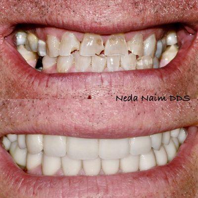 Full Mouth Reconstruction with Zirconia crowns. Smile design by Dr Naim