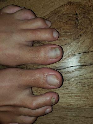 Allll toe nails showing fungus