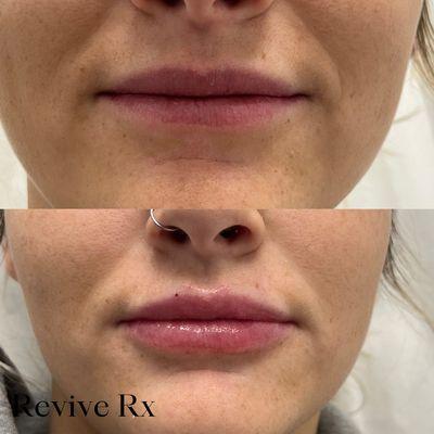 Our lip injections provide softer more hydrated voluminous lips.