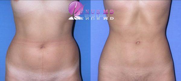 Awake Smartlipo of abdomen in one session without general anesthesia.