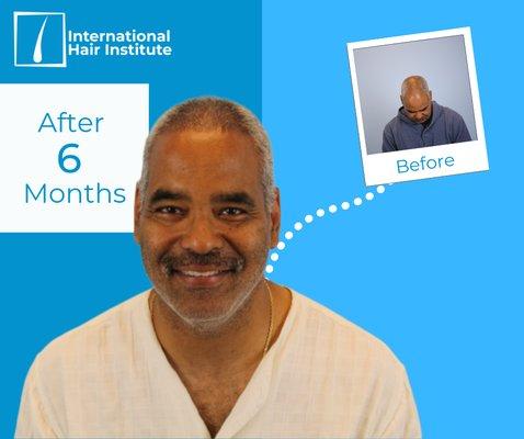 International Hair Institute - Hair Transplant Chicago