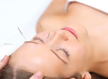 facial rejuvenation acupuncturing.