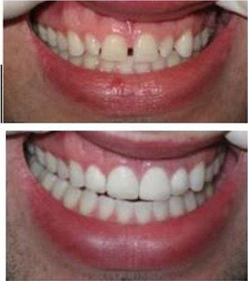 No prep composite veneers