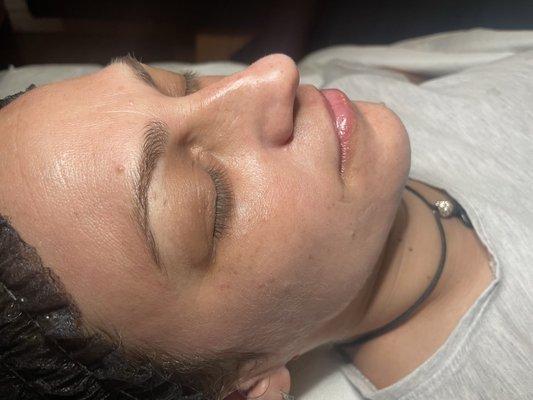 Hydrafacial glow