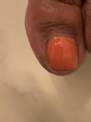 Nail cracking from both toes