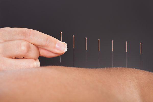 Acupuncture
 Shoulder Pain, Headache Sciatica Pain, Allergy, Reduce Wrinkle Weight Loss, Insomnia, etc.