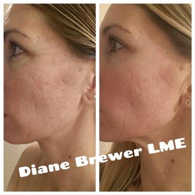 Microneedling for acne scarring