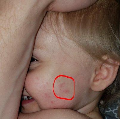 Fingerprint cut on my daughter's cheek from being choked.