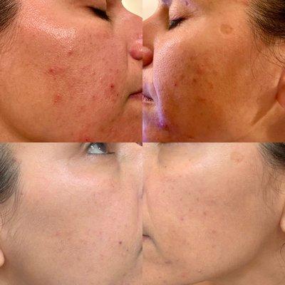 Amazing transformation with HydraFacial and DMK combined modalities.