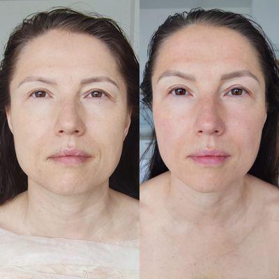 Before/after 1 treatment