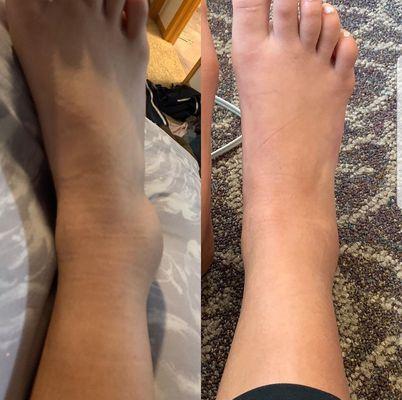 Reduced Ankle Swelling after 1 Treatment