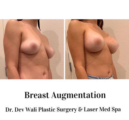 Breast Augmentation