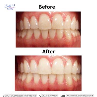 teeth whitening, Hollywood smile