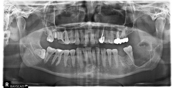 After wisdom tooth was removed on the right side of picture