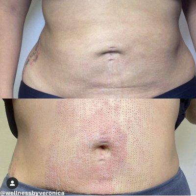 Fibroblast on tummy. Giving the appearance of a tighter abdominal and lifting the skin. Results are immediate.