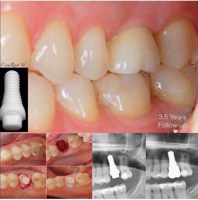 3 years and a half after the surgery, the gum looks great!