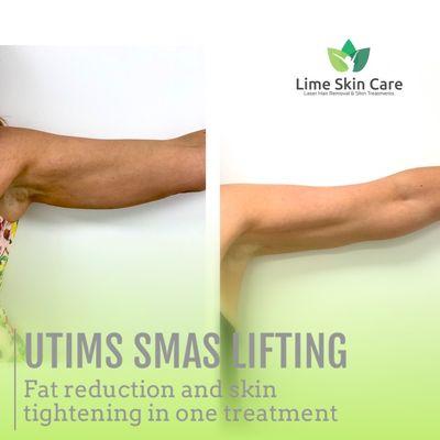 Utims Smas Lifting