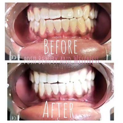 Everyone deserves a bright smile, our teething whitening service will help you be more confident.