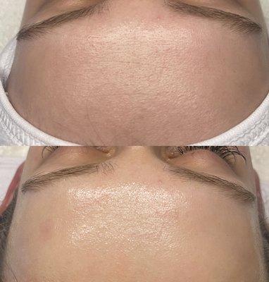 Murad Hydrafacial Booster