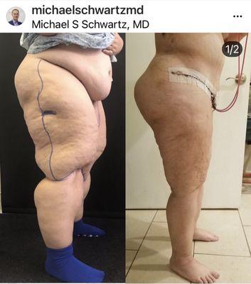 Lipedema patient's Before and After pictures of Vaser Liposuction Legs and abdomen w/ abdominoplasty.