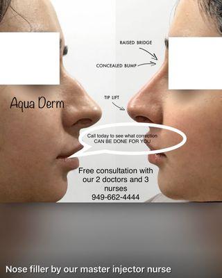 Nose corrections done by our expert dr and nurses call for your appointment today .