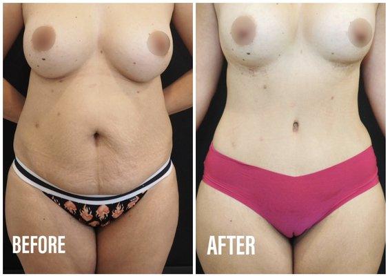 Revision Augmentation- Saline implants to slightly smaller silicone implants & Abdominoplasty/Tummy tuck with liposuction