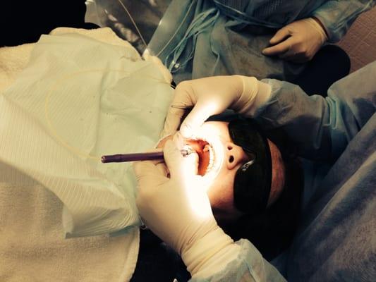 LANAP Laser Periodontal Treatment