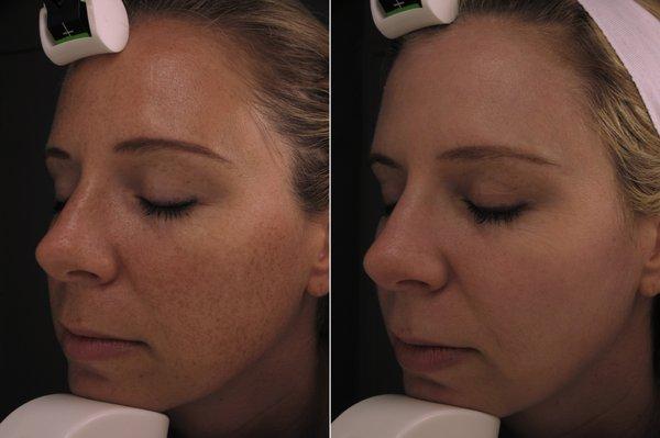 PhotoFacial performed with multiple lasers clears the skin tone, pigmentation, redness.