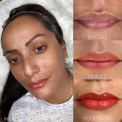 Healed Lip Neutralization