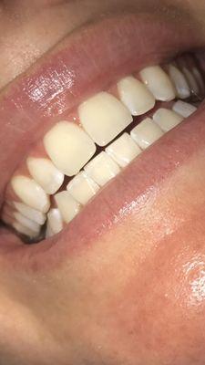 White spots all over the edges of my teeth after ZOOM whitening.....